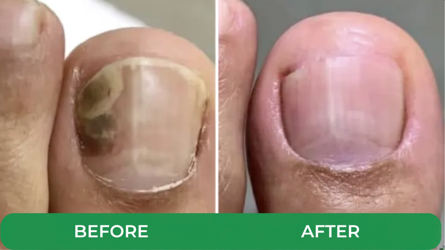 Before and after customer progress photo showing improved nail appearance