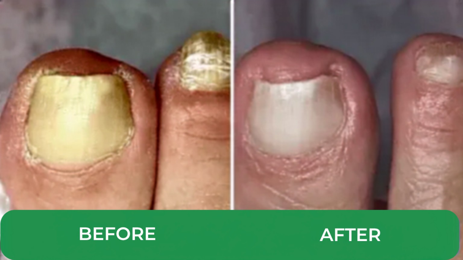 Before and after customer progress photo showing cleaner-looking toenail