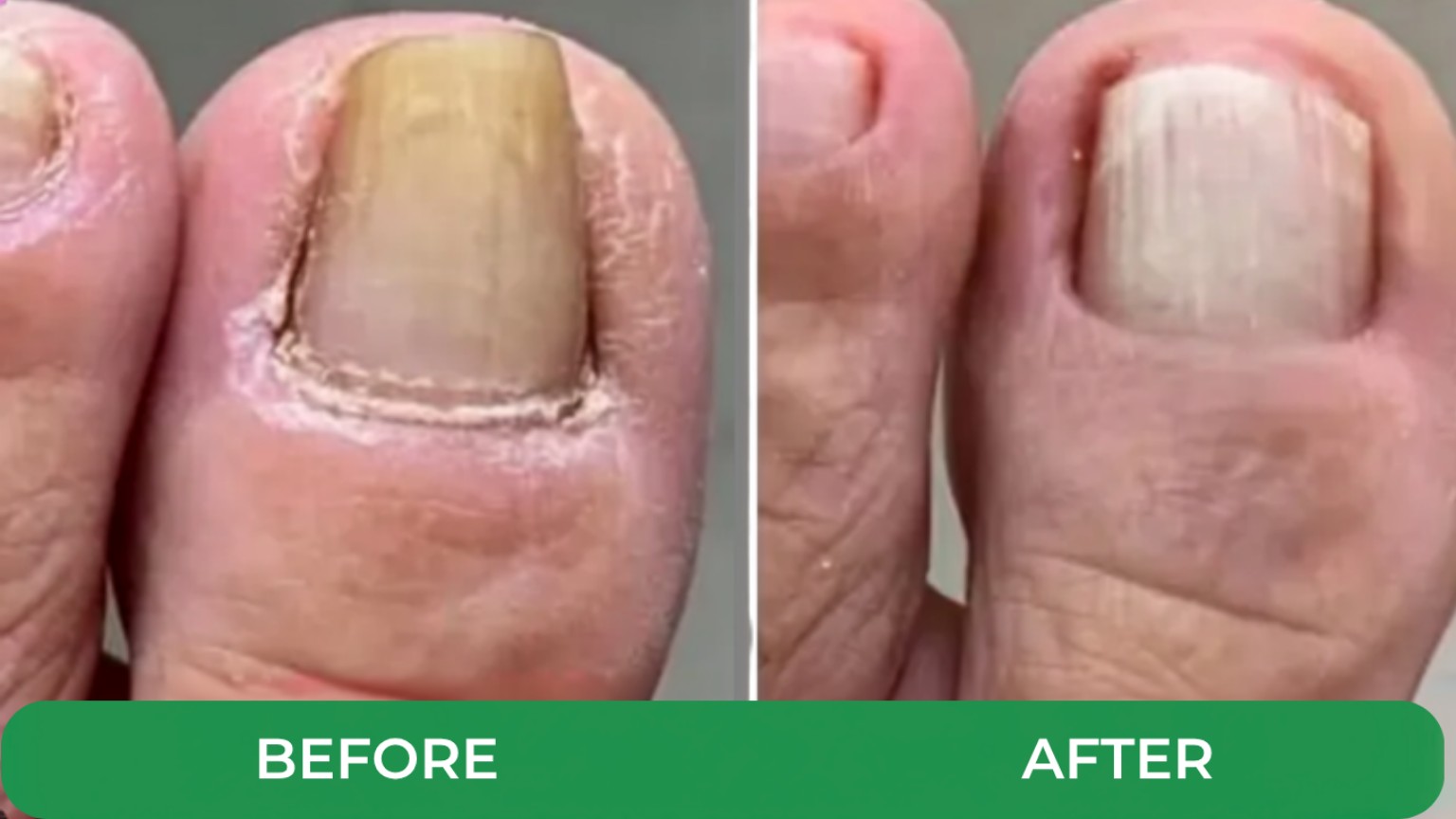 Before and after customer progress photo showing healthier-looking nail appearance