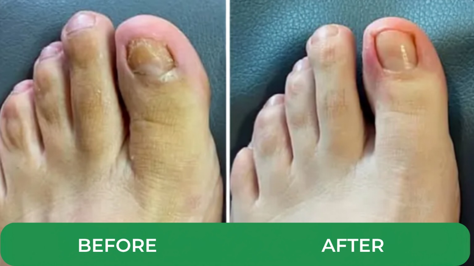 Before and after customer progress photo showing improved foot and nail appearance